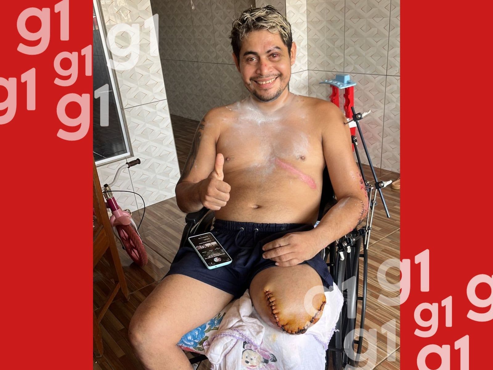 Homem sentado em cadeira de rodas com bandagem no braço em residência no interior do Acre.